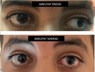 İdil Devlet Hastane’sinde Şaşılık Ameliyatlarına Başlandı 